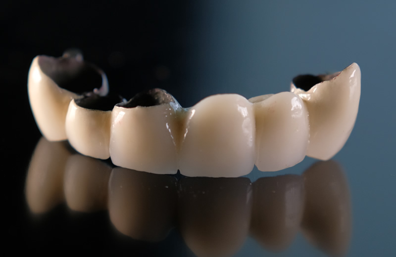 画像：メタルボンド