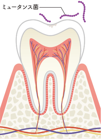 画像：むし歯の進行レベルと症状1