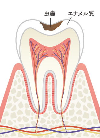 画像：むし歯の進行レベルと症状2