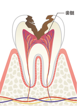 画像：むし歯の進行レベルと症状4
