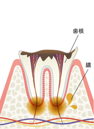 画像：むし歯の進行レベルと症状6