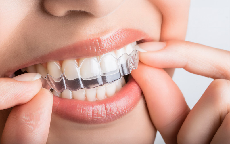 画像：ホワイトニング