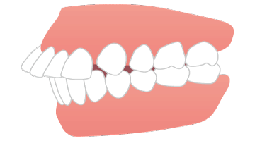 画像：指しゃぶり・舌のクセ